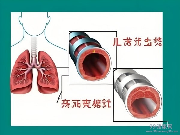 支氣管擴(kuò)張最新治療方案