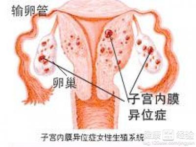 子宮腺肌癥最新治療方法研究與應(yīng)用