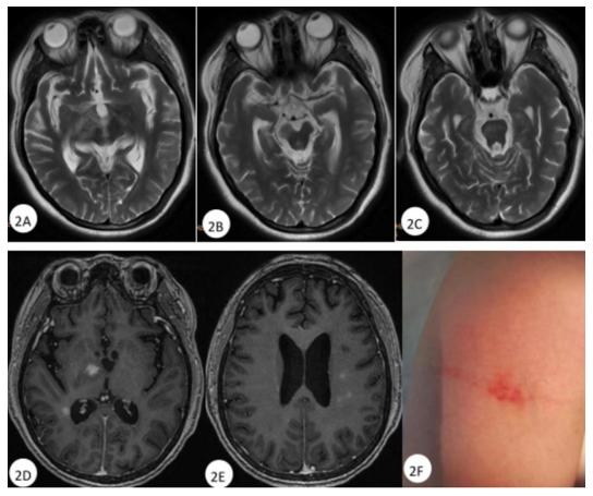 運(yùn)動神經(jīng)元病最新治療方案研究